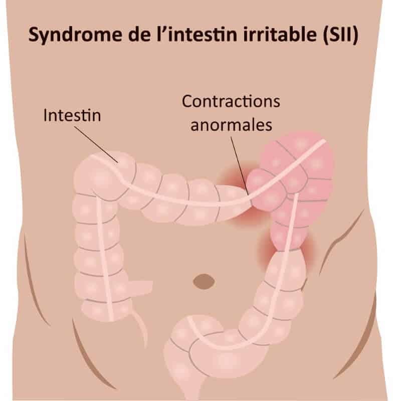 Le syndrôme de l'intestin irritable et le CBD | CBDISSIMO
